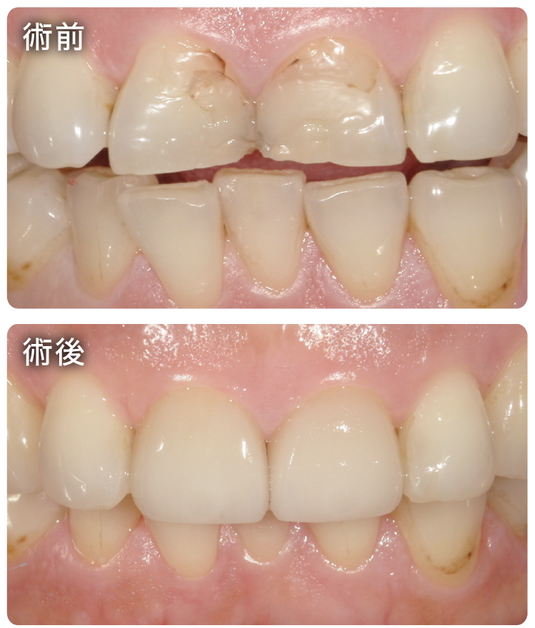 ラミネートベニア治療症例