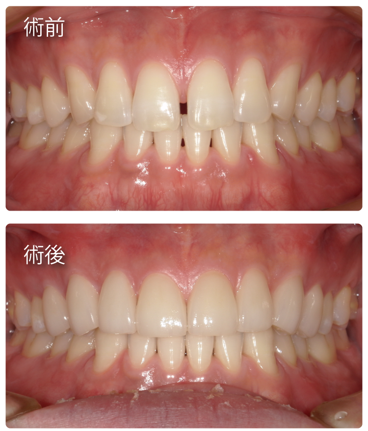 ラミネートベニア治療症例