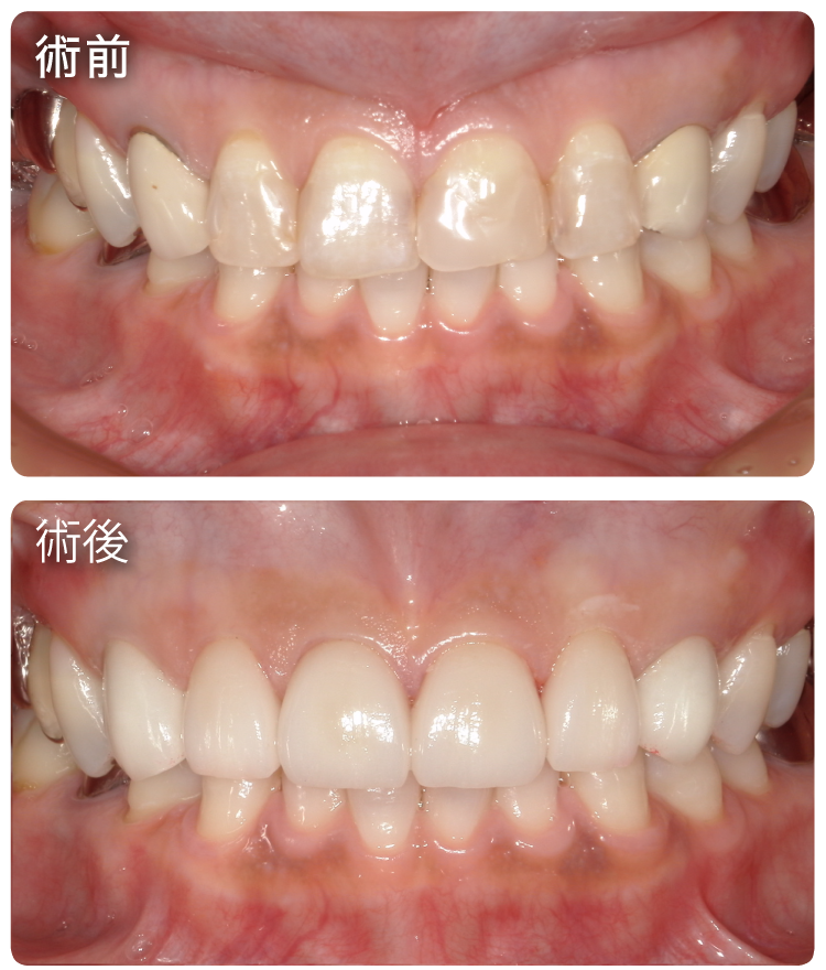 セラミック治療症例