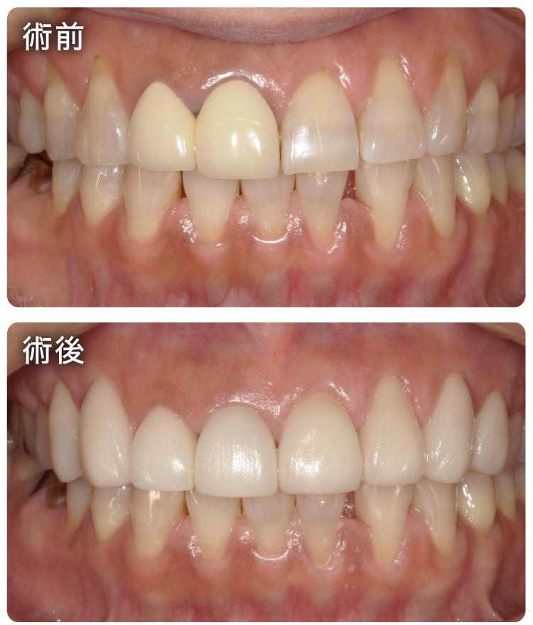 ラミネートベニア治療症例