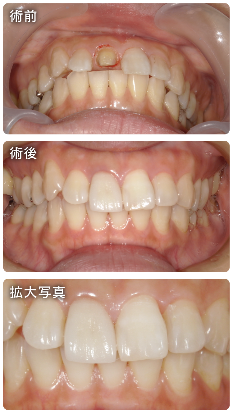 セラミック治療症例