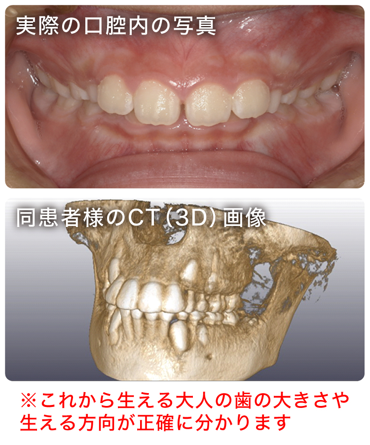 矯正治療においてのCT