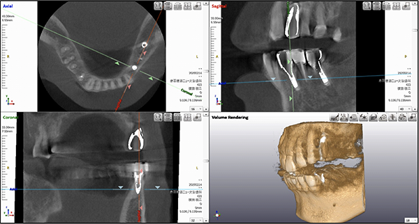 インプラント治療においてのCT