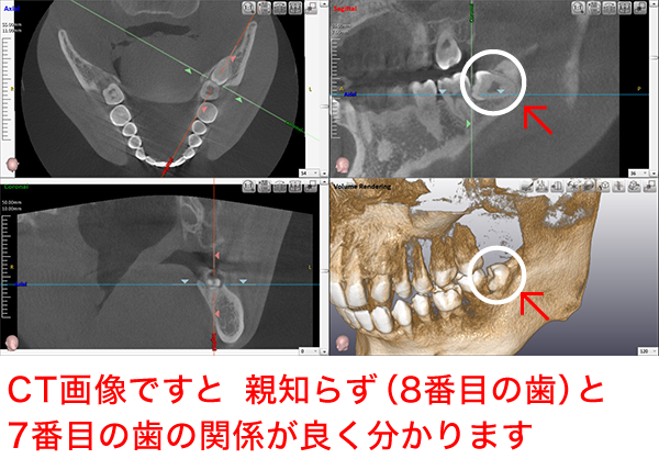 親知らずにおいてのCT