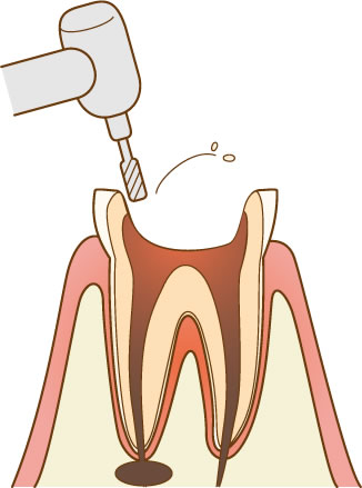 根管治療
