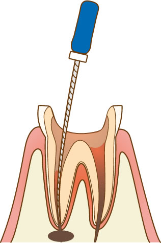 根管治療