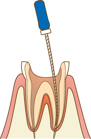 根管治療