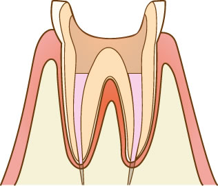 根管治療