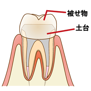 根管治療