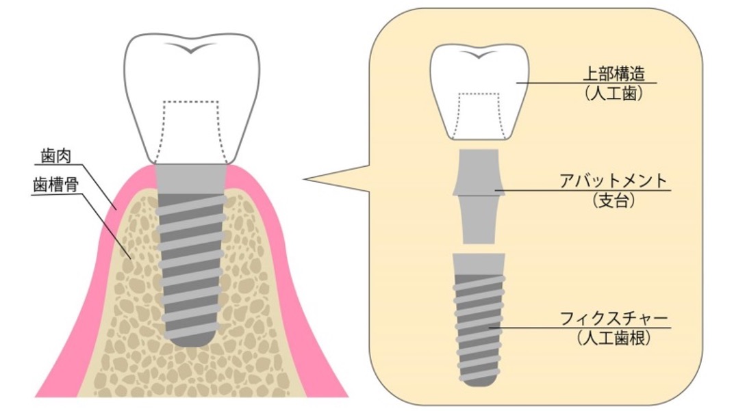 インプラントの構造