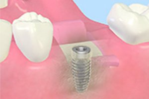 フィクスチャー埋入