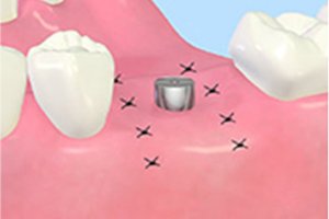 アバットメント装着