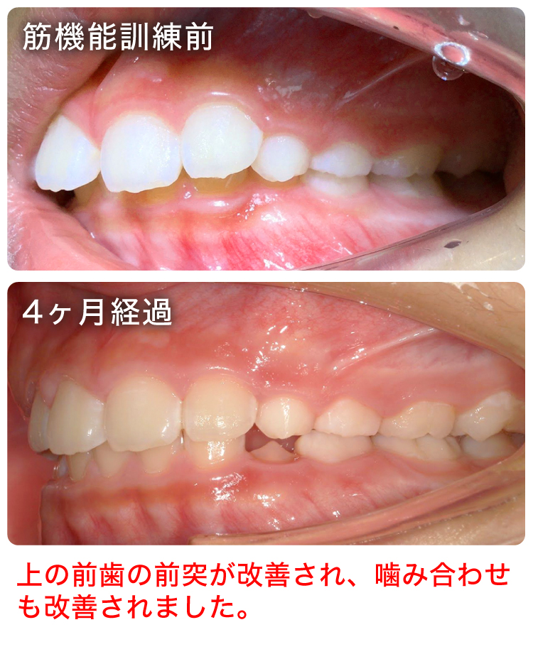 筋機能訓練症例