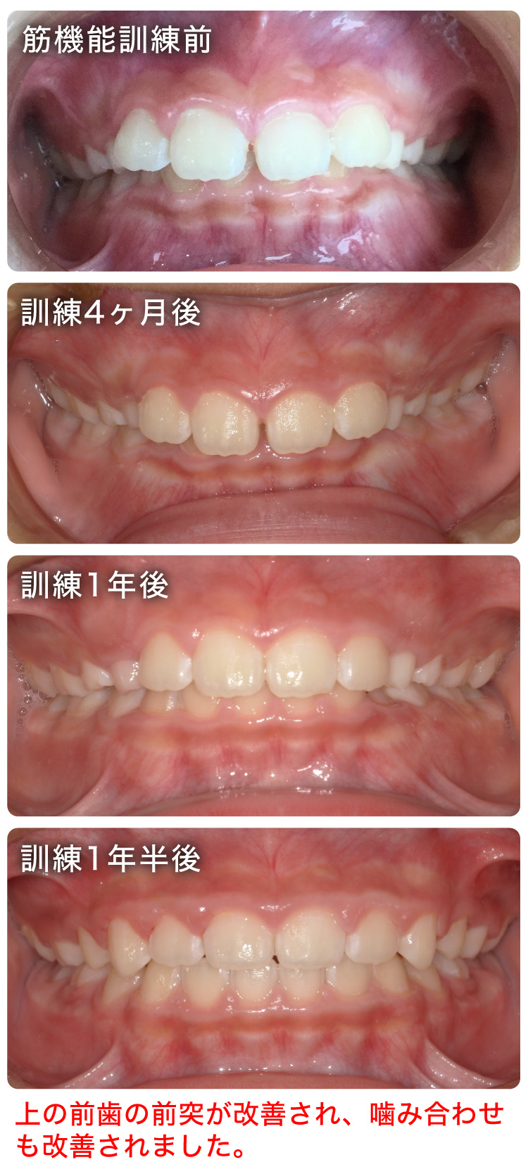 筋機能訓練症例