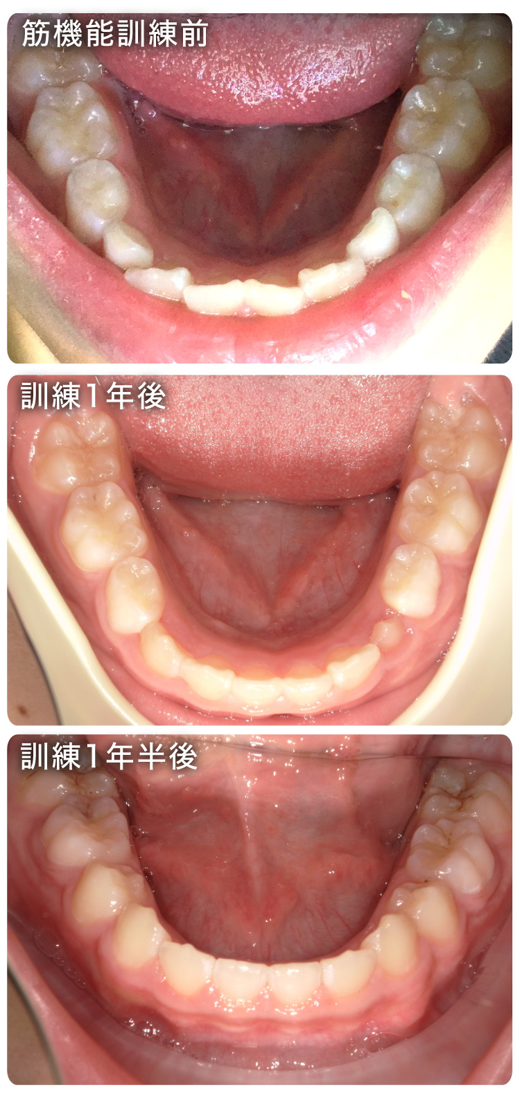 筋機能訓練症例