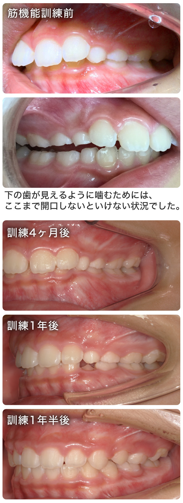 筋機能訓練症例