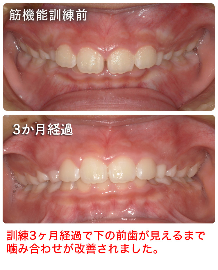 筋機能訓練症例