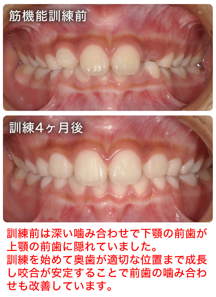 筋機能訓練症例