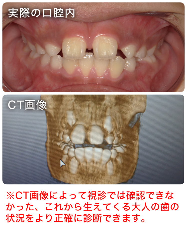 こどもの矯正