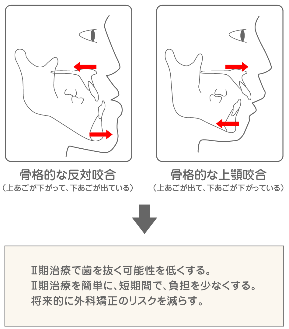 こどもの矯正