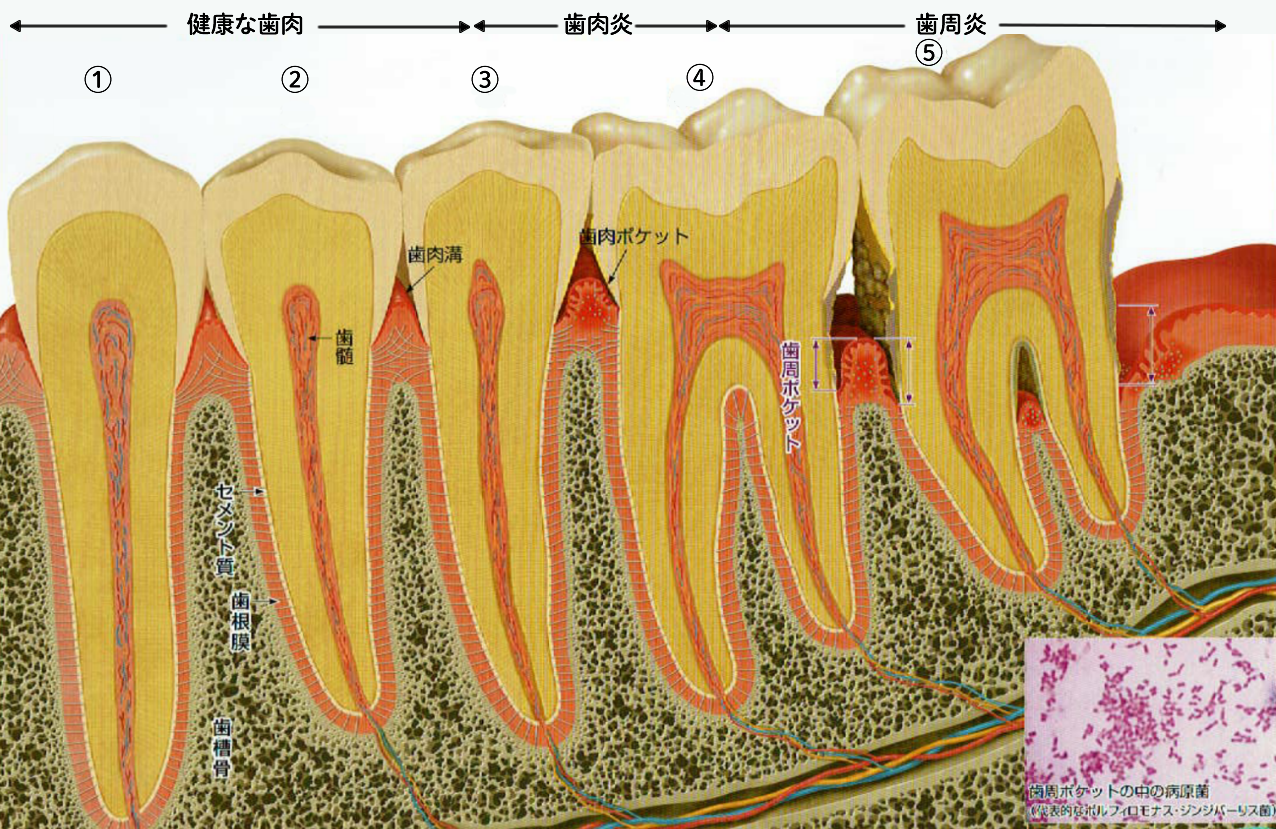 歯周病の病態