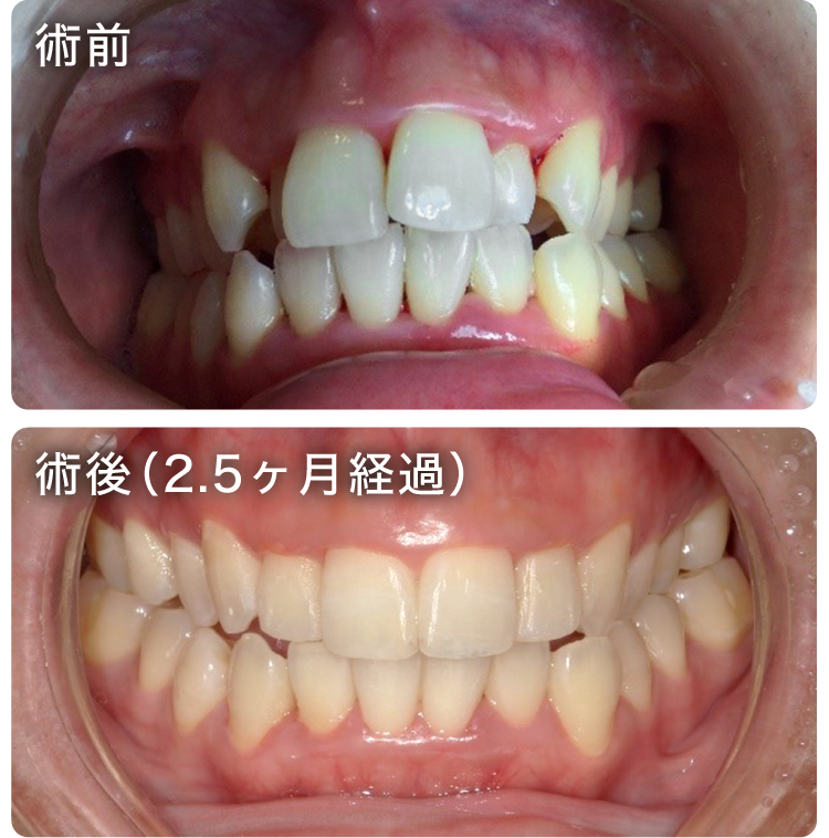Speedクリア矯正症例