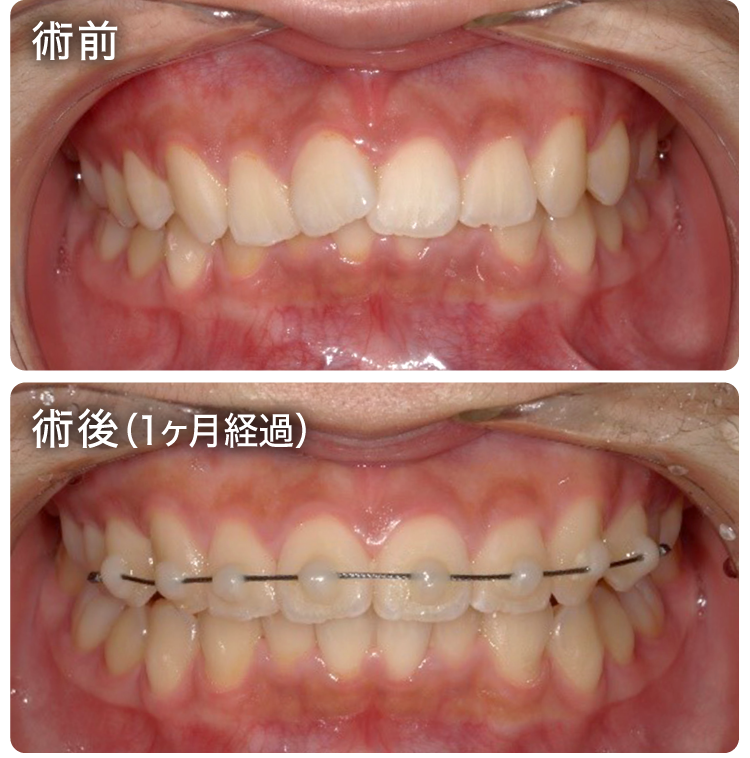Speedクリア矯正症例