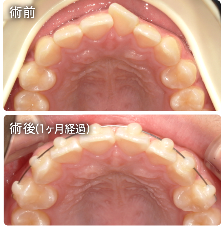 Speedクリア矯正症例